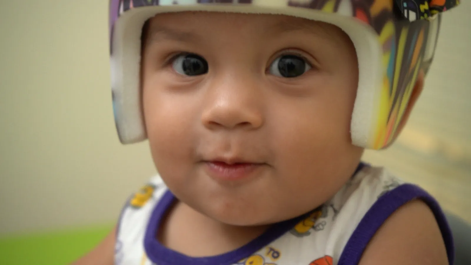 A smiling baby wearing a colorful cranial helmet at Hope