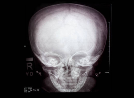Head Deformity- Its Types & Helmet Therapy – Hope Abilitation Medical Center – Dubai