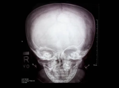 Head Deformity- Its Types & Helmet Therapy – Hope Abilitation Medical Center – Dubai
