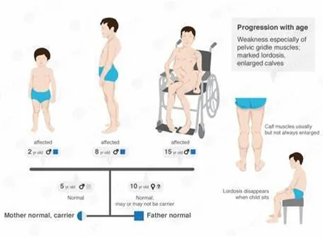 MUSCULAR DYSTROPHY - Hope Abilitation Medical Center