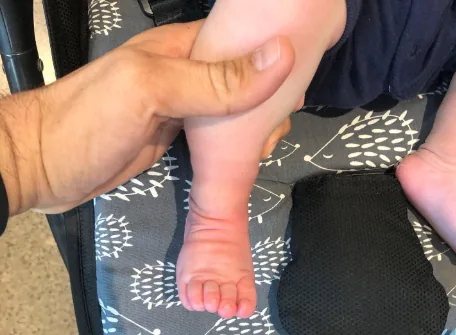 Osteosarcoma or Bone Tumor in Legs in Children