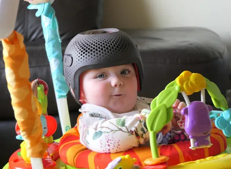 Parents Should Know These Three Things About Baby Helmet Therapy - Hope AMC - Dubai