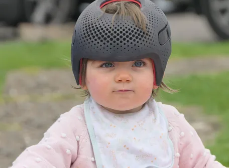 Plagiocephaly Helmet Therapy: How Effective It Is? – Hope Abilitation Medical Center