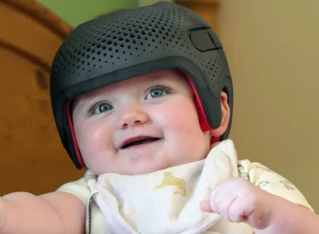 What is Helmet Therapy? What Kinds of Head Deformities in Babies Can It Treat?