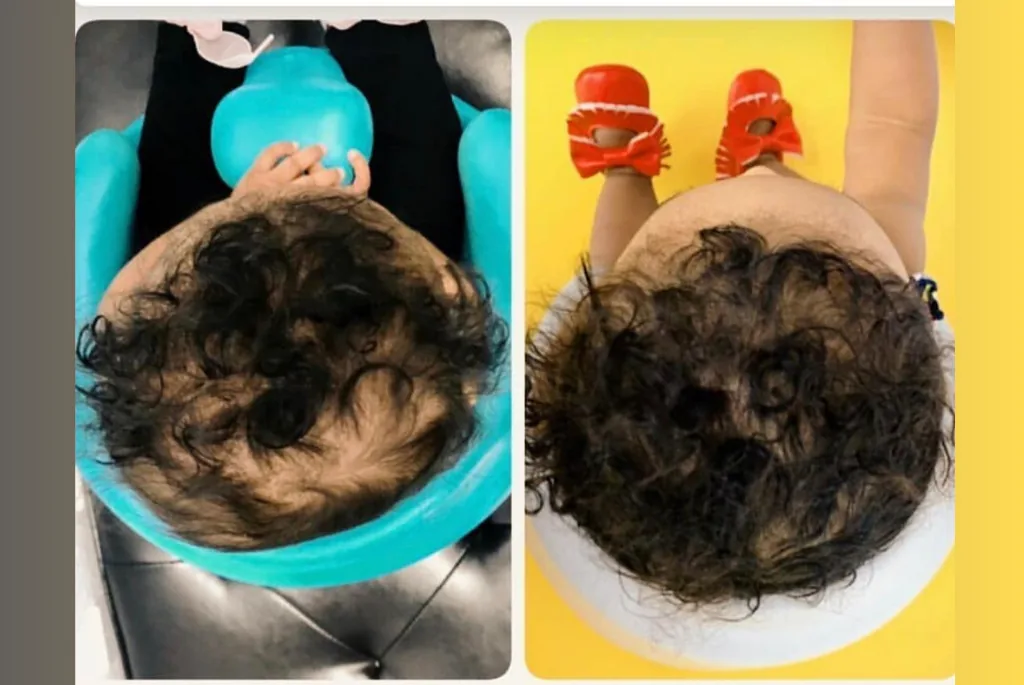 Helmet therapy before and after result 5