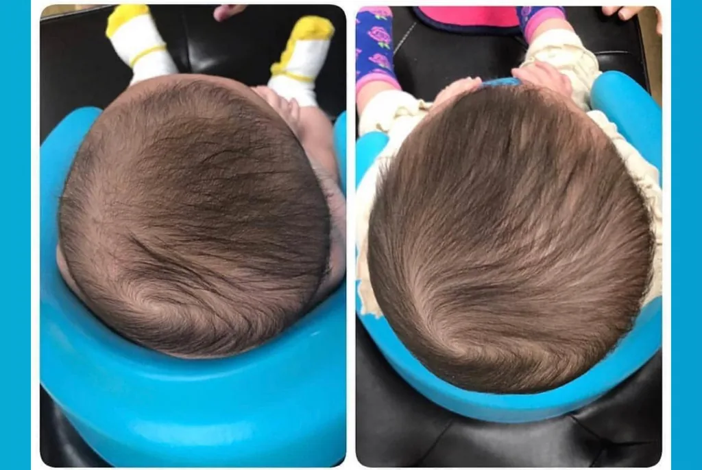 Helmet therapy before and after result 3