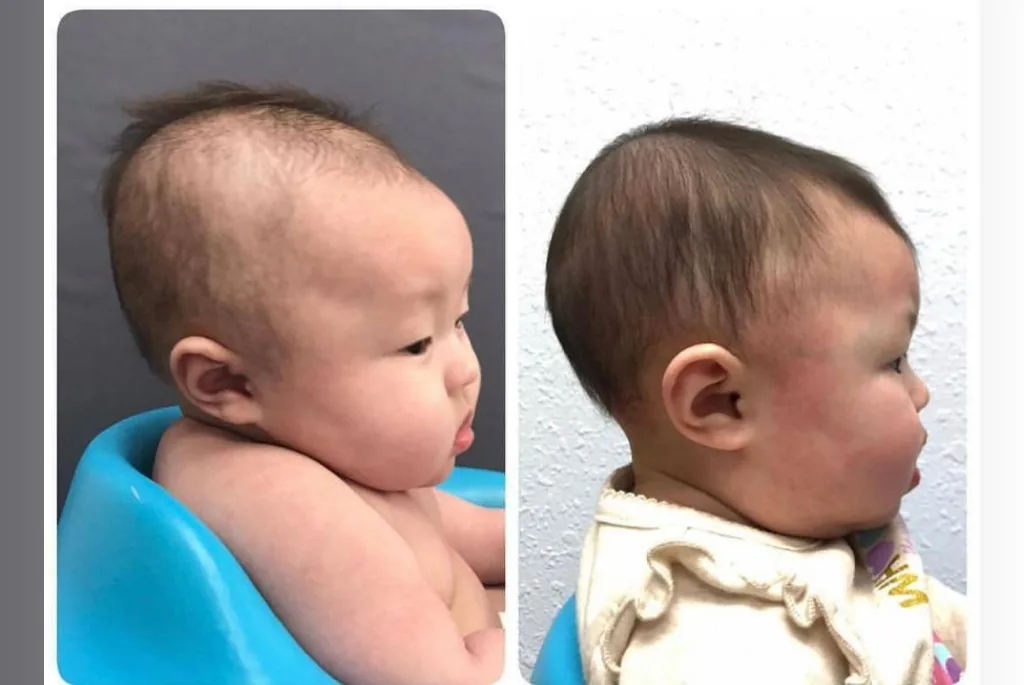 Helmet therapy before and after result 2