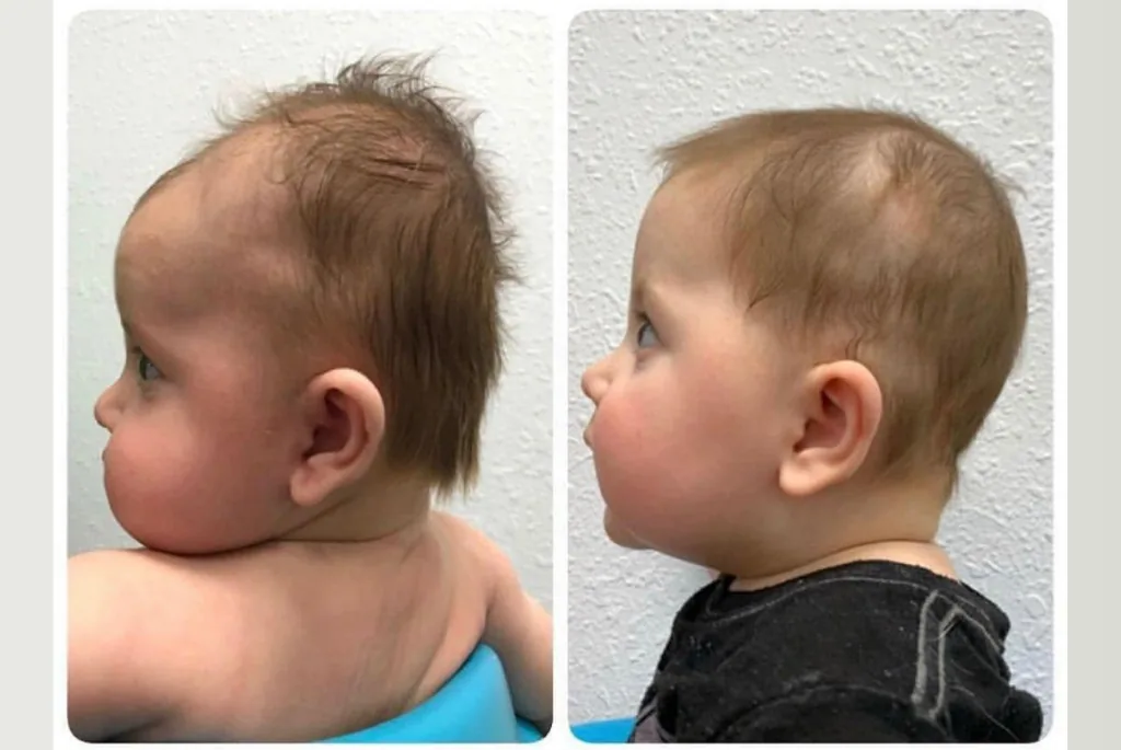 Helmet therapy before and after result 1